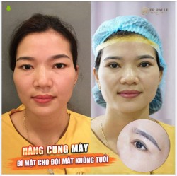 TRẺ RA 10 TUỔI NHỜ TIỂU PHẪU NÂNG CUNG MÀY TẠI DR.HẢI LÊ