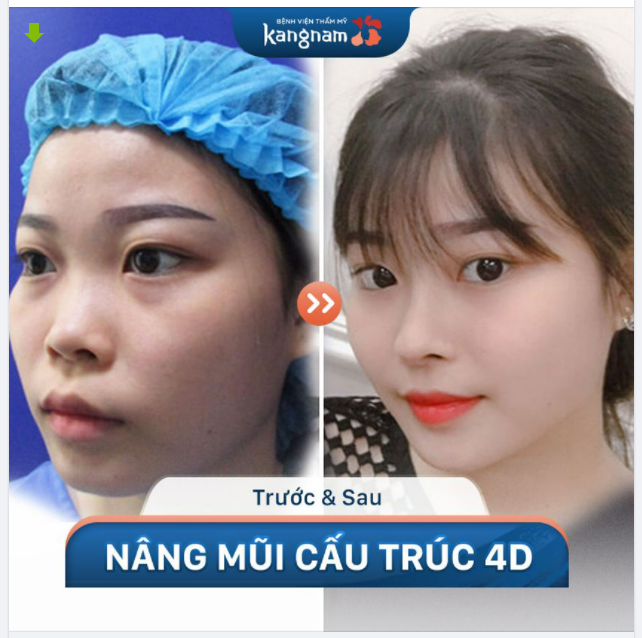 Trẻ trung như NỮ SINH nhờ Nâng mũi cấu trúc 4D