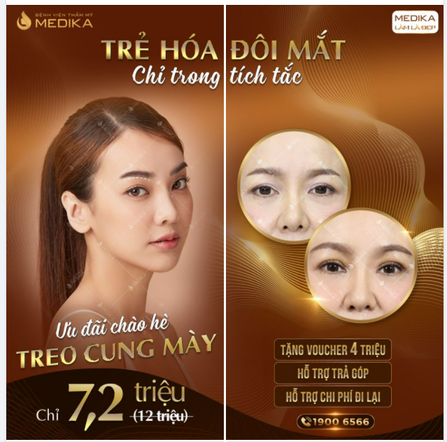 TREO CUNG MÀY - BÍ KÍP TRẺ HÓA ĐÔI MẮT TRONG TẦM TAY