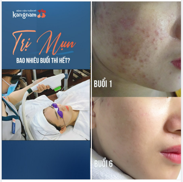 "Trị mụn mấy buổi thì hết?""