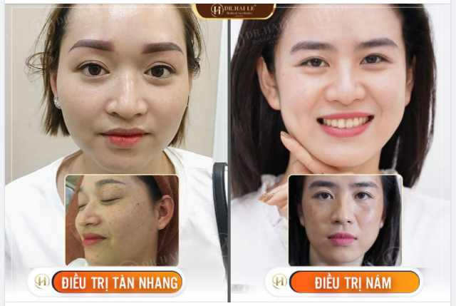 TRỊ NÁM, TÀN NHANG Ở ĐÂU HIỆU QUẢ VÀ AN TOÀN?
