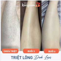 Triệt lông muốn sạch "dứt điểm" cần liệu trình mấy buổi?