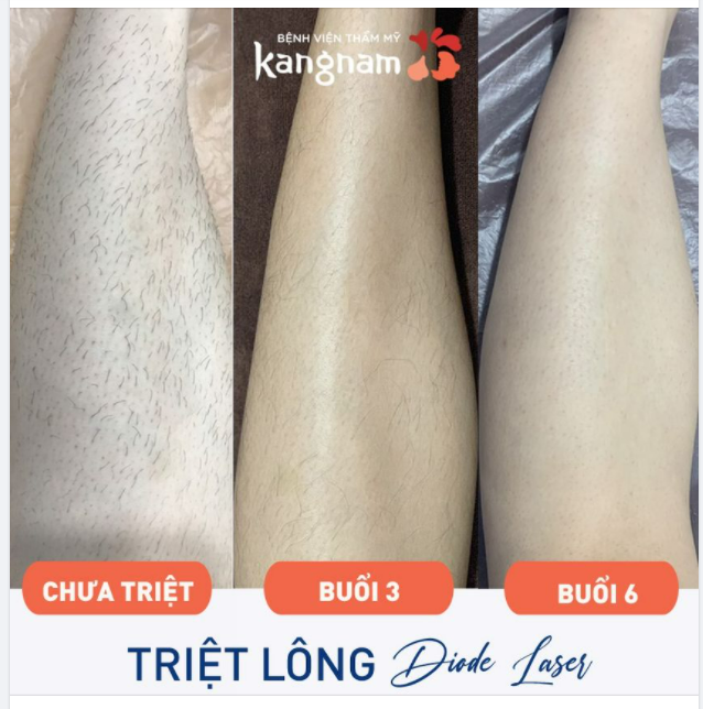 Triệt lông muốn sạch "dứt điểm" cần liệu trình mấy buổi?