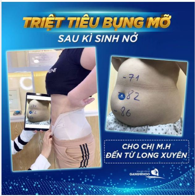 TRIỆT TIÊU BỤNG MỠ - SAU KÌ SINH NỞ CHO CHỊ M.H ĐẾN TỪ LONG XUYÊN