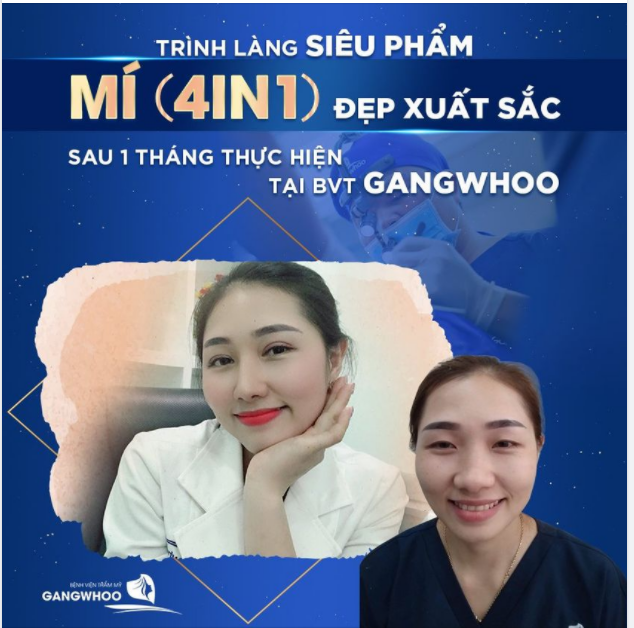 TRÌNH LÀNG SIÊU PHẨM MÍ (4IN1) ĐẸP XUẤT SẮC SAU 1 THÁNG THỰC HIỆN TẠI BVTM GANGWHOO