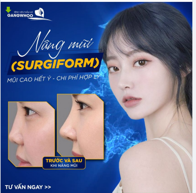 TRỢ GIÁ MÙA DỊCH - NÂNG MŨI SURGIFORM, MŨI ĐẸP HẾT Ý - NGẠI GÌ CHI PHÍ