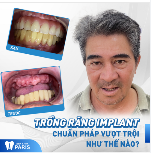 Trồng Implant Chuẩn Pháp Vượt Trội Như Thế Nào?