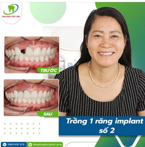 TRỒNG IMPLANT KHÔNG ĐAU - PHÙ HỢP CHO MỌI LỨA TUỔI