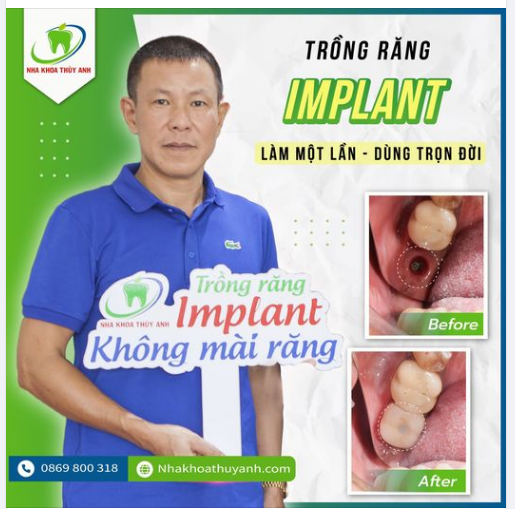 TRỒNG IMPLANT KHÔNG ĐAU - PHÙ HỢP CHO MỌI LỨA TUỔI
