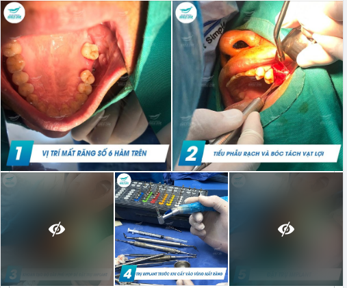 TRỒNG IMPLANT - THOẢI MÁI ĂN NHAI - TỰ TIN GIAO TIẾP