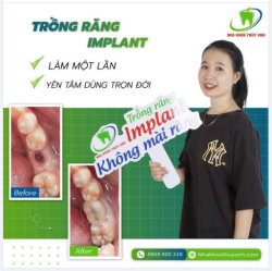 TRỒNG RĂNG 1 LẦN, ĂN NHAI TRỌN ĐỜI