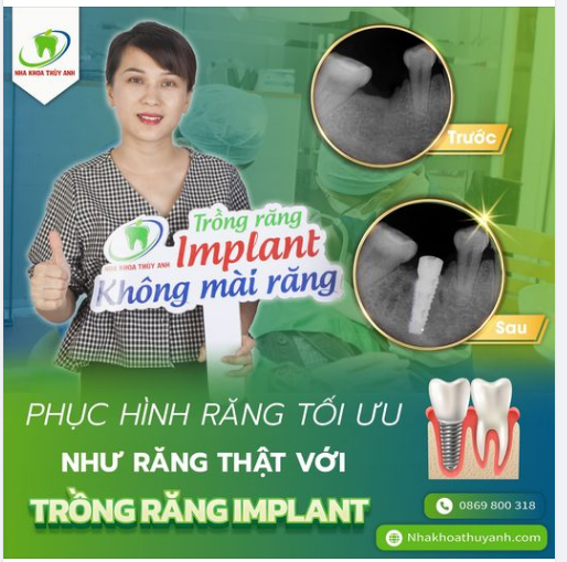 TRỒNG RĂNG 1 LẦN TỐI ƯU LÂU DÀI BẰNG IMPLANT