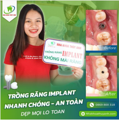 TRỒNG RĂNG CHẮC CHẮN CHẲNG NGẠI KHÓ ĂN NHAI