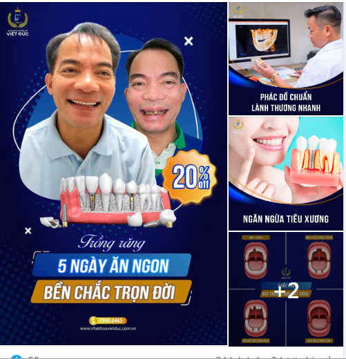 TRỒNG RĂNG IMPLANT 5 NGÀY CÓ NGAY RĂNG THẬT