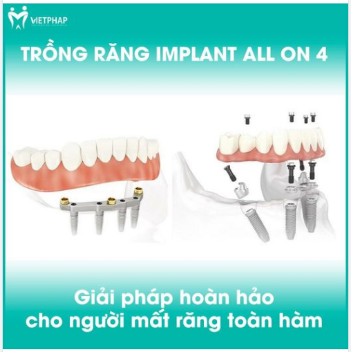 TRỒNG RĂNG IMPLANT ALL ON 4 - GIẢI PHÁP HOÀN HẢO CHO NGƯỜI MẤT RĂNG TOÀN HÀM