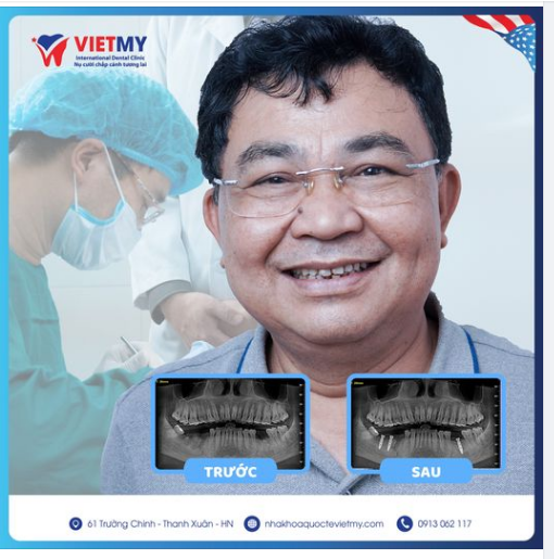 Trồng răng Implant cho chú Ninh đến từ Thanh Trì- Hà Nội