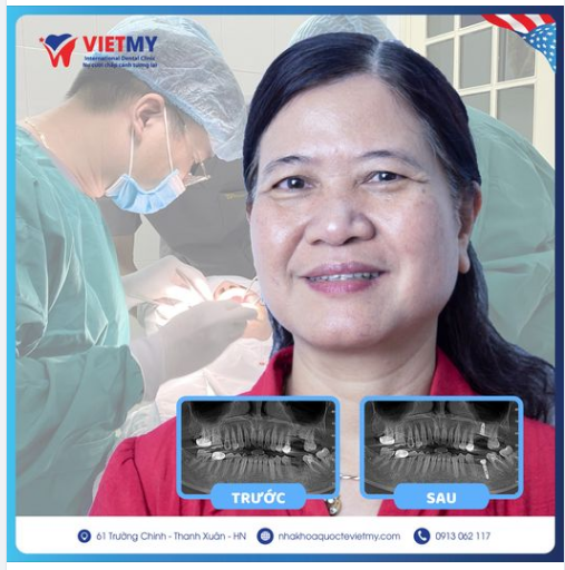 Trồng răng Implant cho cô Hương đến từ Hòa Bình