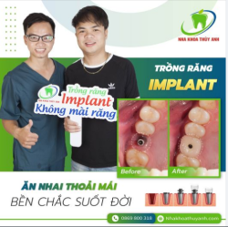 TRỒNG RĂNG IMPLANT SỚM - ĐẢM BẢO ĂN NHAI NHƯ RĂNG THẬT