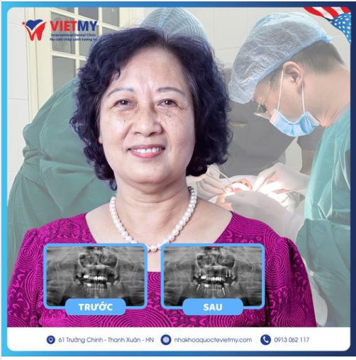 TRỒNG RĂNG IMPLANT- HIỆN THỰC HÓA NỤ CƯỜI TỰ TIN