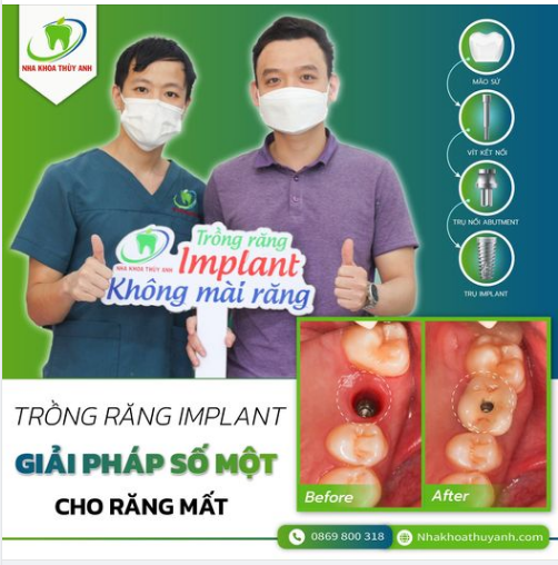 TRỒNG RĂNG SỚM - LOẠI BỎ SỚM NGUY CƠ DO MẤT RĂNG.
