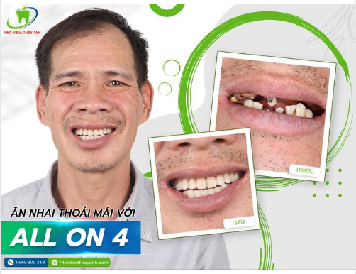 TRỒNG RĂNG TOÀN HÀM ALL ON 4 - LẤY LẠI PHONG ĐỘ, KHÔI PHỤC SỨC NHAI