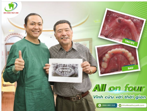 TRỒNG RĂNG TOÀN HÀM ALL ON 4 - SỰ ĐẦU TƯ XỨNG ĐÁNG CHO SỨC KHOẺ CỦA BỐ MẸ BẠN