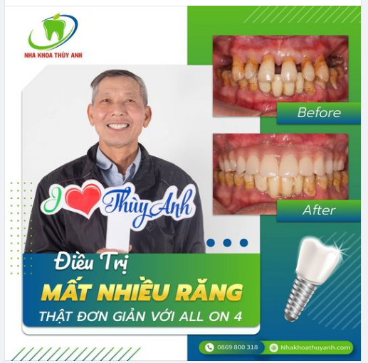 TRỒNG RĂNG TOÀN HÀM - TRẢ LẠI SỨC NHAI NHƯ THỜI TRẺ