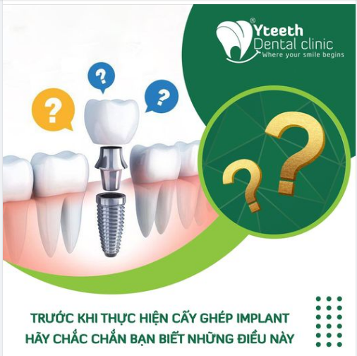 TRƯỚC KHI THỰC HIỆN CẤY GHÉP IMPLANT - HÃY CHẮC CHẮN BẠN BIẾT NHỮNG ĐIỀU NÀY