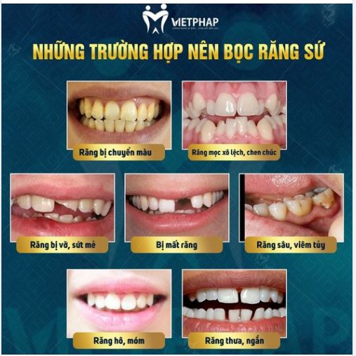 TRƯỜNG HỢP NÀO NÊN BỌC RĂNG SỨ