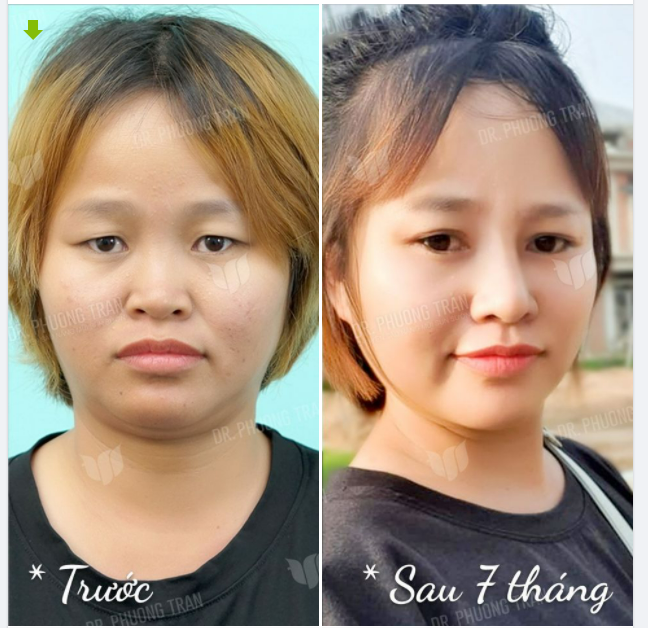 TỪ LÚC EM LÀM MŨI LÀ EM ĐÃ BÁN THÊM ĐƯỢC 3 CĂN NHÀ NỮA