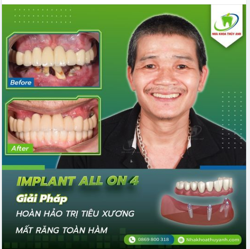 Từ một nụ cười móm mém do mất răng