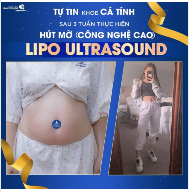 TỰ TIN KHOE CÁ TÍNH SAU 3 TUẦN THỰC HIỆN HÚT MỠ CÔNG NGHỆ CAO LIPO ULTRASOUND