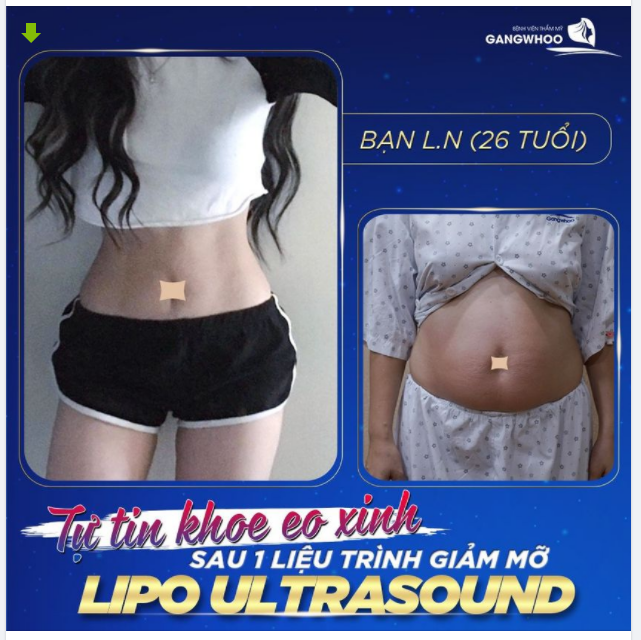 TỰ TIN KHOE EO XINH SAU 1 LIỆU TRÌNH GIẢM MỠ LIPO ULTRASOUND