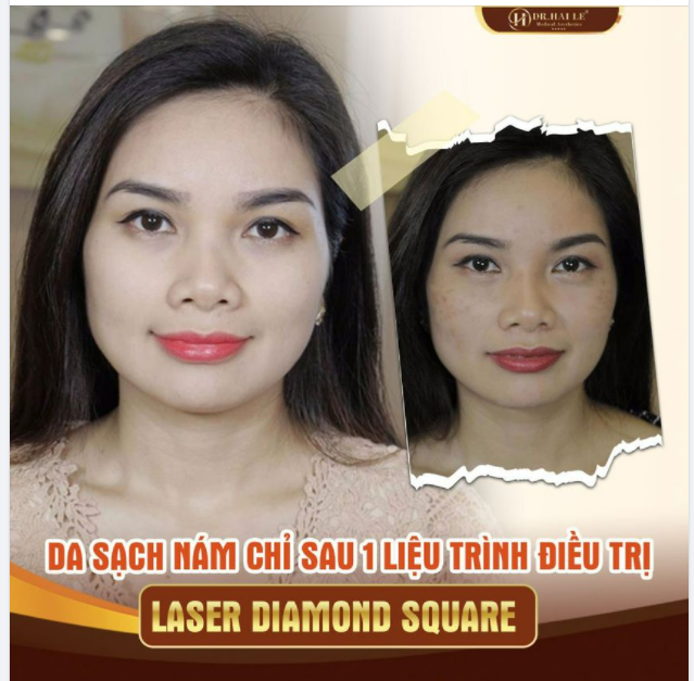 Tự tin khoe mặt mộc thách thức cam thường sau khi điều trị nám với công nghệ Laser Diamond Square và trẻ hóa da tại Dr.Hải Lê