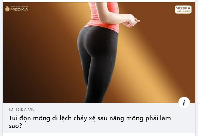 Túi độn mông di lệch, chảy xệ sau một thời gian phẫu thuật nâng mông là biến chứng không mong muốn.