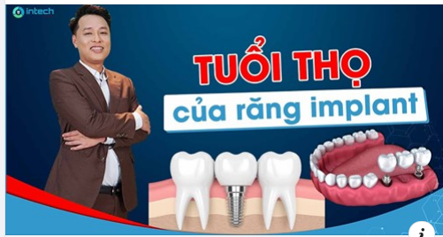 TUỔI THỌ CỦA RĂNG IMPLANT CAO NHẤT KHI TRỒNG TẠI NHA KHOA LẠC VIỆT INTECH LÀ BAO NHIÊU NĂM?