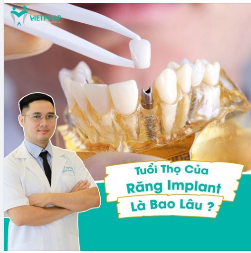 TUỔI THỌ CỦA RĂNG IMPLANT LÀ BAO LÂU?