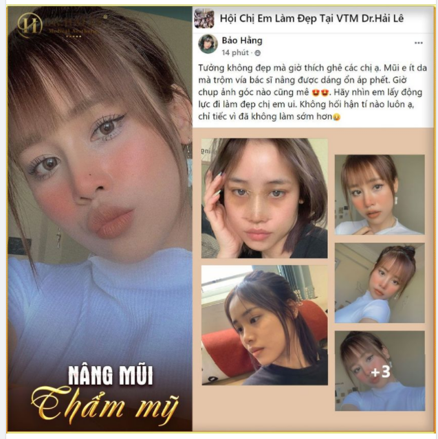 Tưởng không đẹp mà đẹp không tưởng, nàng ấy hối hận vì không đi nâng mũi sớm hơn.....