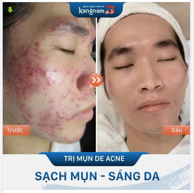 "Tưởng không hết mụn, mà có 2 buổi đã gần như sạch luôn"