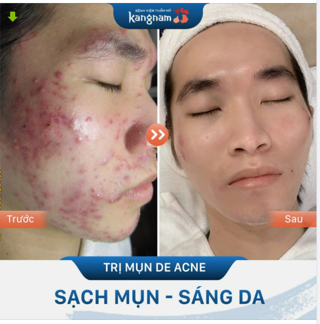 "Tưởng không hết mụn, mà có 2 buổi đã gần như sạch luôn"