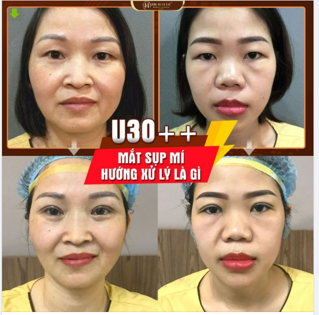 U30++ Mắt sụp mí già nua phải làm sao?