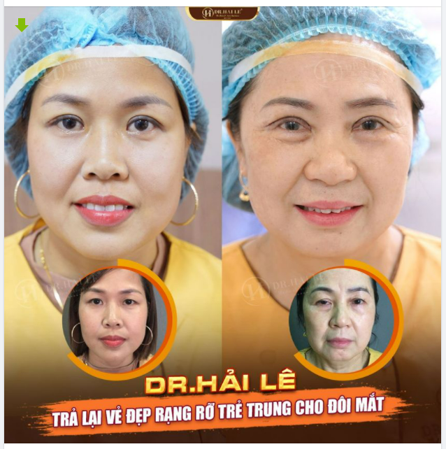 U30++ Mắt sụp mí già nua phải làm sao?