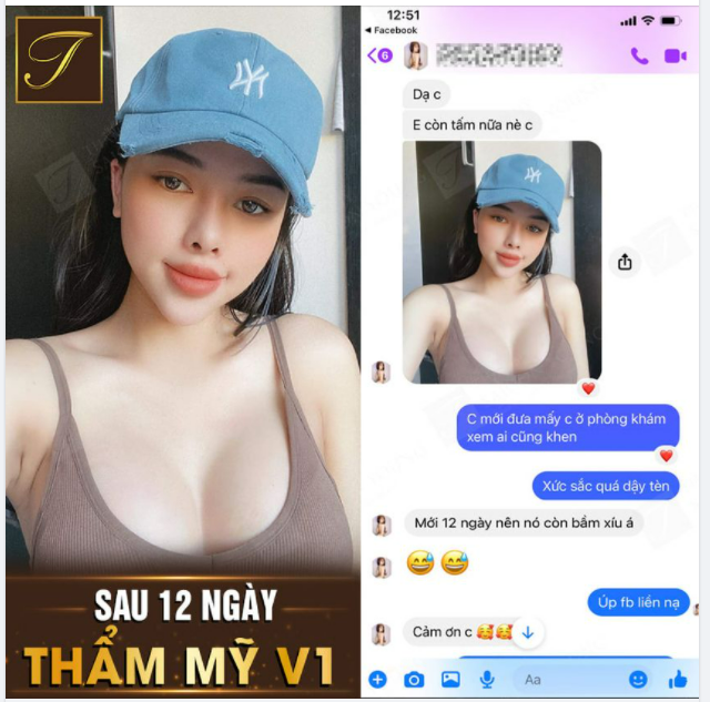 V1 SAU 12 NGÀY THẨM MỸ NHƯ THẾ NÀO?