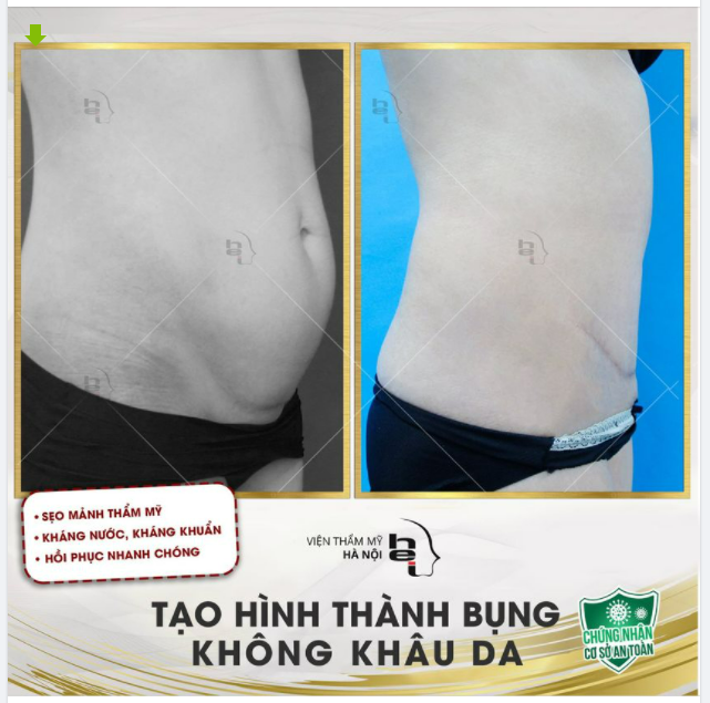 Vấn đề bụng nhiều da chùng, chảy xệ luôn là mối quan tâm của chị em sau sinh.