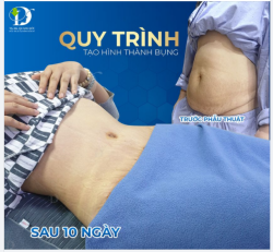 Vẫn nhiều bạn nhắn hỏi phương pháp phẫu thuật tạo hình thành bụng là gì nên nhân dịp cuối tuần, bác sĩ sẽ mô tả kỹ trong bài viết này cho các bạn "ngâm cứu" thêm nhé