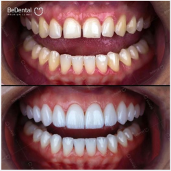 Veneer được xem là "áo giáp sứ bảo vệ răng" chắc chắn mà không xâm lấn răng gốc, mang lại vẻ đẹp hoàn mỹ khi cười