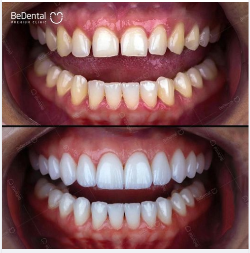Veneer được xem là "áo giáp sứ bảo vệ răng" chắc chắn mà không xâm lấn răng gốc, mang lại vẻ đẹp hoàn mỹ khi cười