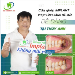 VÌ SAO IMPLANT HIỆN NAY LẠI ĐƯỢC LỰA CHỌN NHIỀU ĐẾN VẬY