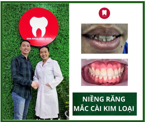 VÌ SAO NIỀNG RĂNG MẮC CÀI KIM LOẠI ĐƯỢC SỬ DỤNG RỘNG RÃI HIỆN NAY