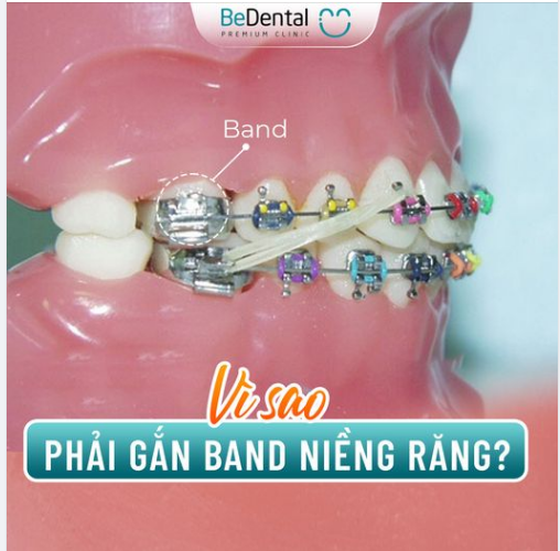 VÌ SAO PHẢI GẮN BAND NIỀNG RĂNG?